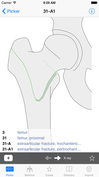 Tibial shaft - Diagnosis - AO Surgery Reference