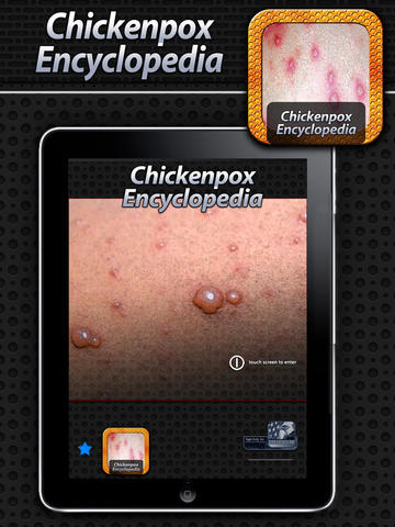 Chickenpox Encyclopedia