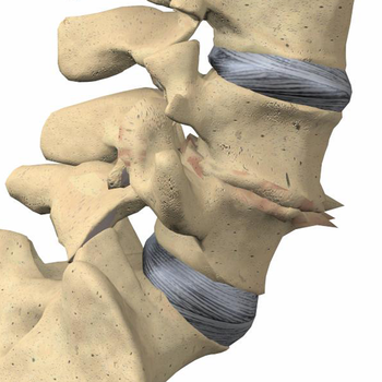 mLumbarDegenerativeDiscDisease LOGO-APP點子