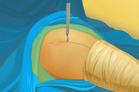 Hip Surgery Simulation screenshot 3