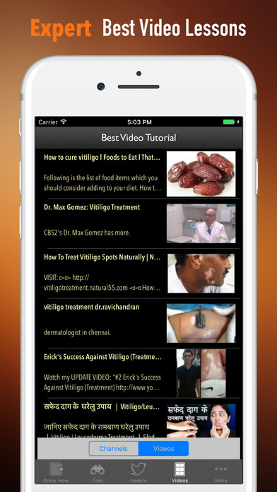 Vitiligo 101-Treatment Tips and Remedies Guide screenshot 3