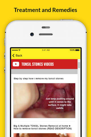 Tonsil Stones - Treatment and Remedies screenshot 4